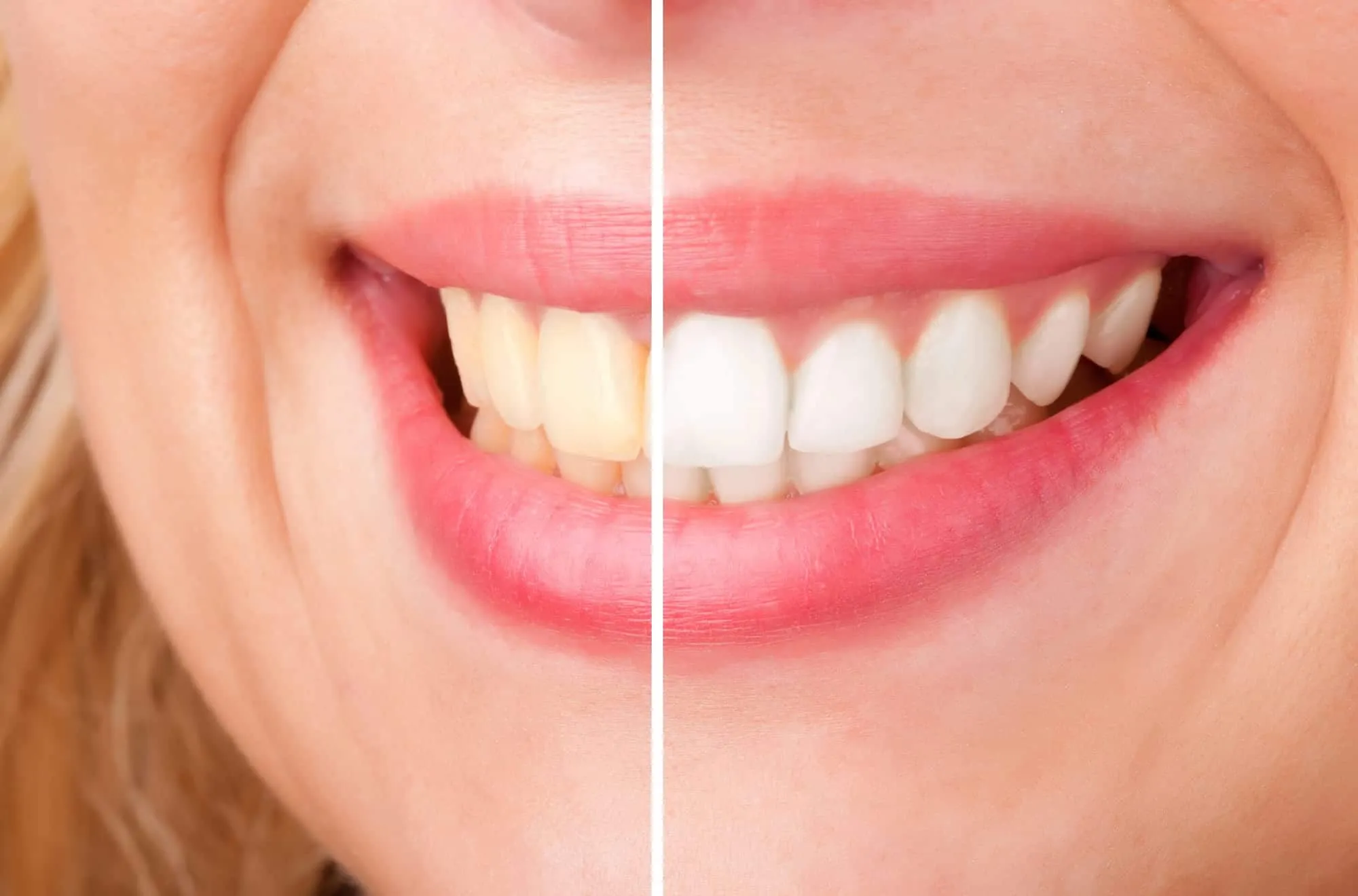 Des astuces naturelles pour un sourire éclatant et des dents blanches
